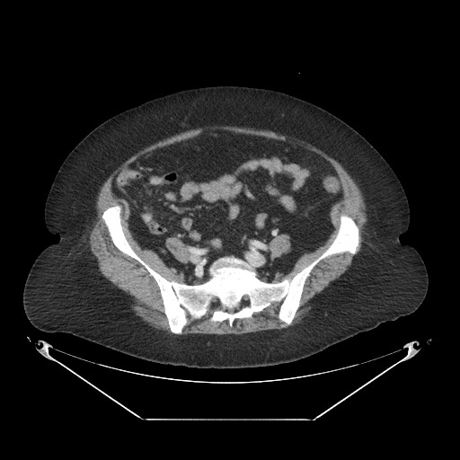 Closed loop small bowel obstruction - internal hernia (Radiopaedia 65402-74450 A 94).jpg