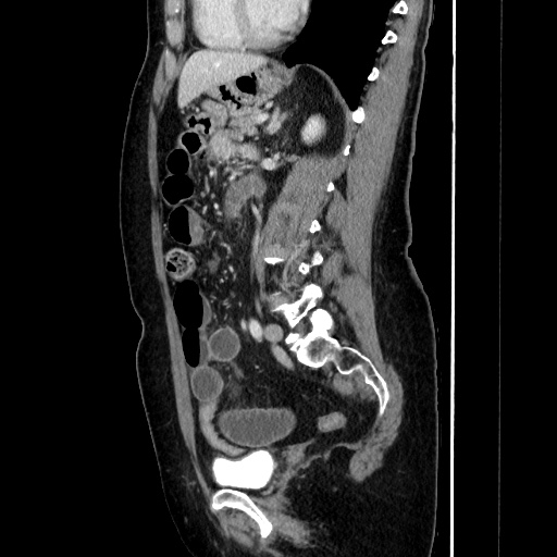 Closed loop small bowel obstruction due to adhesive bands - early and late images (Radiopaedia 83830-99015 C 107).jpg
