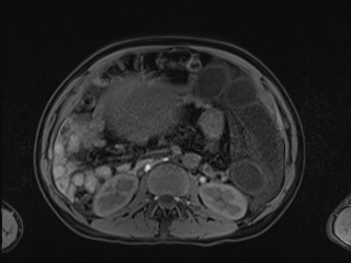 Closed loop small bowel obstruction in pregnancy (MRI) (Radiopaedia 87637-104031 Axial T1 fat sat 58).jpg