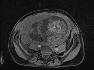 Closed loop small bowel obstruction in pregnancy (MRI) (Radiopaedia 87637-104031 F 27).jpg