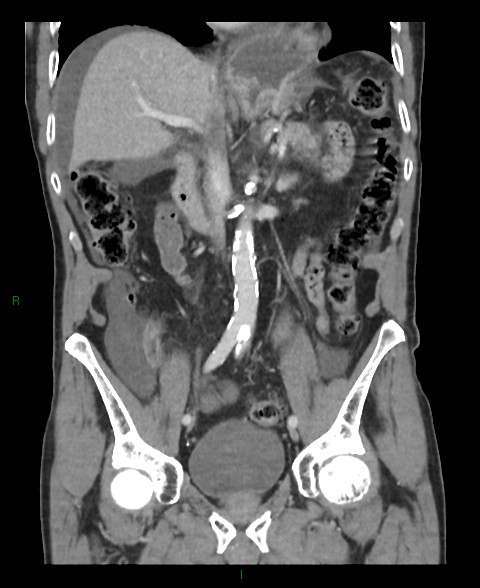 File:Closed loop small bowel obstruction with ischemia (Radiopaedia 84180-99456 B 34).jpg