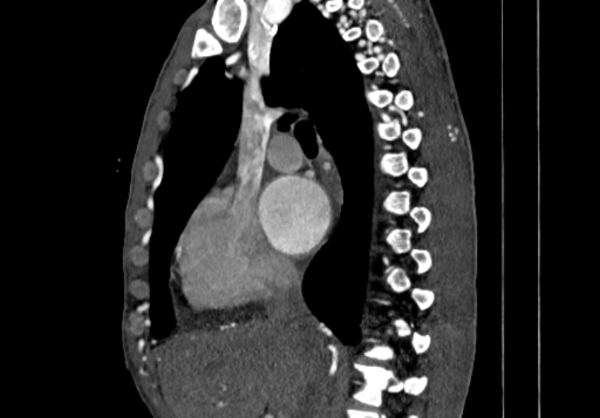 Coarctation of aorta with aortic valve stenosis (Radiopaedia 70463-80574 B 23).jpg