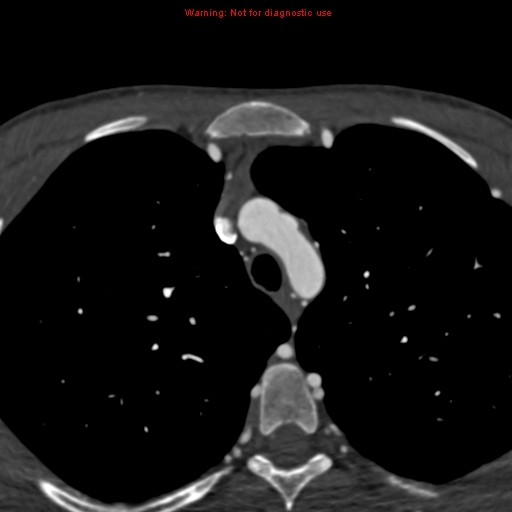 File:Coarctation of the aorta (Radiopaedia 12461-12697 A 38).jpg