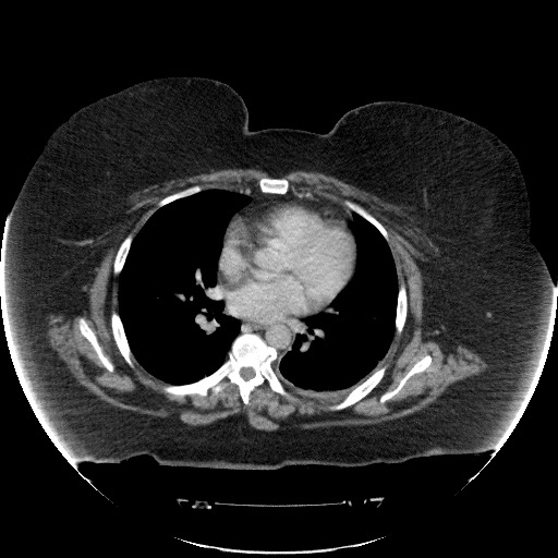 File:Collection due to leak after sleeve gastrectomy (Radiopaedia 55504-61972 A 5).jpg