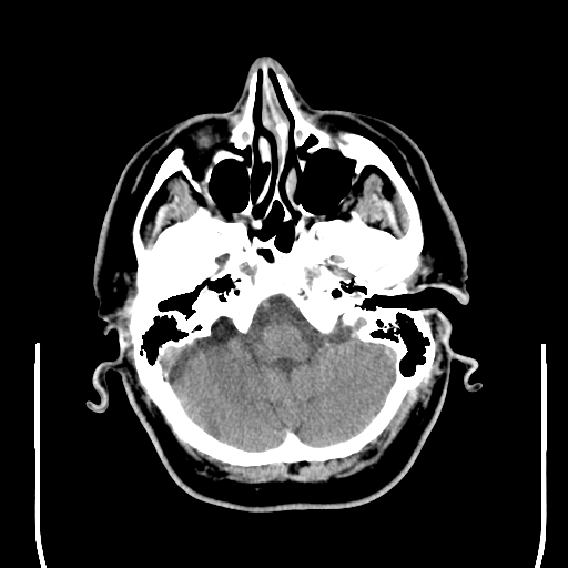 File:Colloid cyst (large) (Radiopaedia 34415-35734 Axial non-contrast 14).png