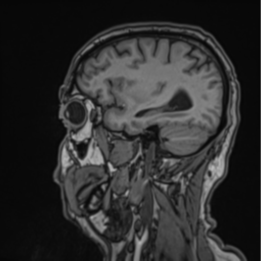 File:Colloid cyst of the third ventricle (Radiopaedia 86571-102662 Sagittal T1 57).png