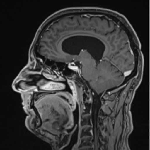 File:Colloid cyst of the third ventricle (Radiopaedia 86571-102662 Sagittal T1 C+ 43).png