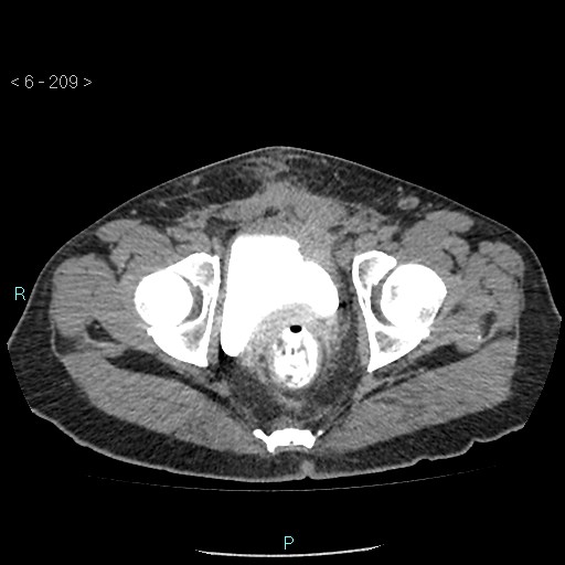 File:Colo-cutaneous fistula (Radiopaedia 40531-43129 A 87).jpg