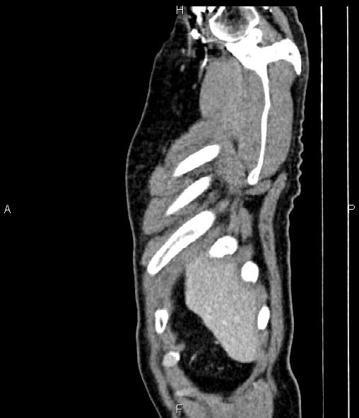 Colon adenocarcinoma (Radiopaedia 83266-97671 D 12).jpg