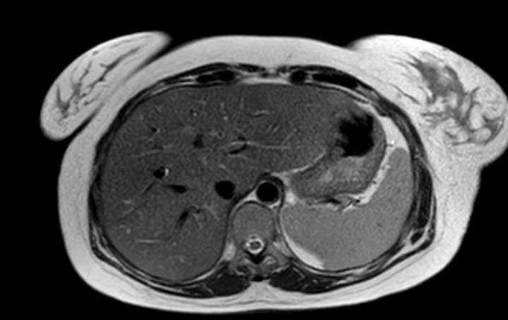 Colon adenocarcinoma with Krukenberg tumors, advanced pregnancy (Radiopaedia 67279-76645 Axial T2 70).jpg