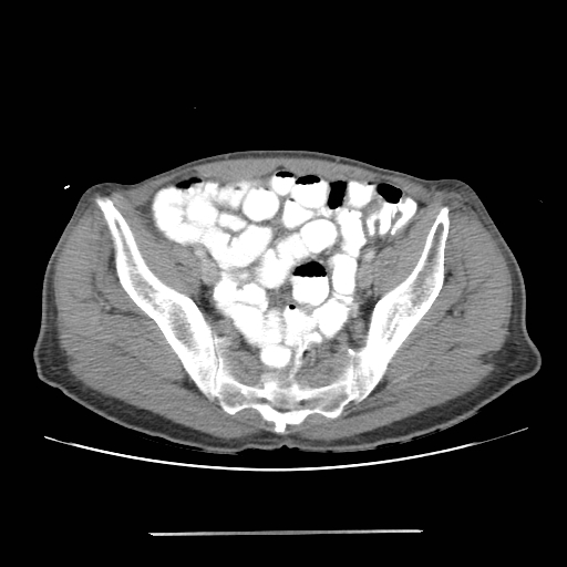 File:Colon cancer with calcified liver metastasis (Radiopaedia 74423-85307 A 63).jpg
