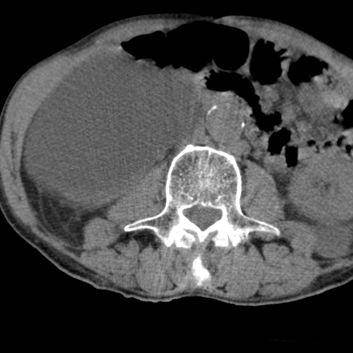 Colon cancer with calcified liver metastasis (Radiopaedia 74423-85309 Axial non-contrast 50).jpg