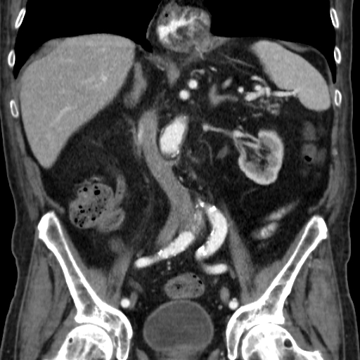 File:Colon cancer with duodenal invasion (Radiopaedia 16278-15958 B 34).jpg