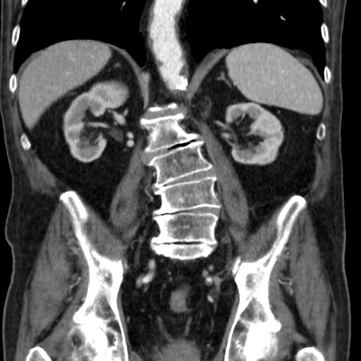 File:Colon cancer with duodenal invasion (Radiopaedia 16278-15958 B 40).jpg