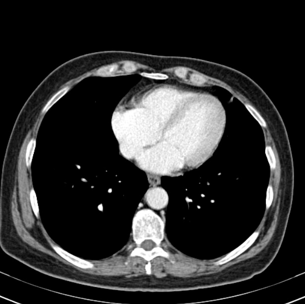 Colon carcinoma with hepatic metastases (Radiopaedia 29477-29961 A 1).jpg