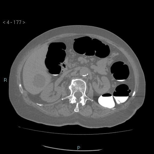 File:Colonic lipomas (Radiopaedia 49137-54244 Axial bone window 79).jpg