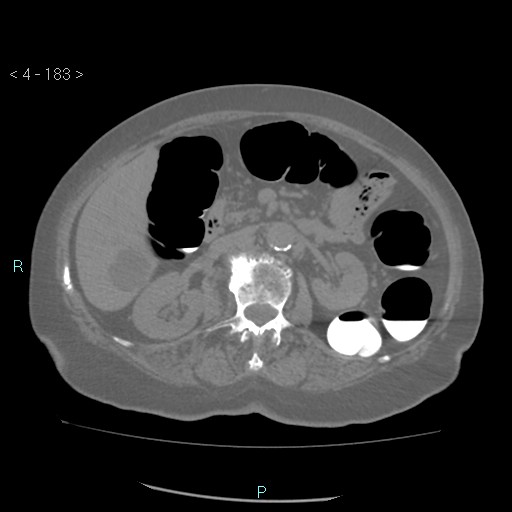 Colonic lipomas (Radiopaedia 49137-54244 Axial bone window 81).jpg