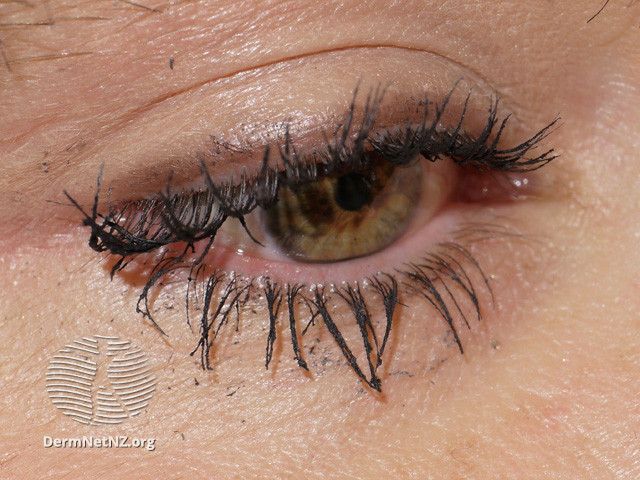 File:Effect of bimatoprost solution on eyelashes (DermNet NZ treatments-bimatoprost02).jpg
