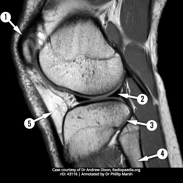 File:MRI knee - sagittal (anatomy quiz) (Radiopaedia 60297).jpg