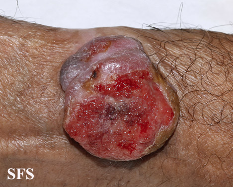 File:Melanoma (Dermatology Atlas 52).jpg