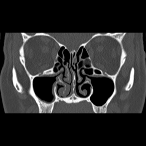 Nasal septal perforation (Radiopaedia 25030-25289 Coronal bone window 34).jpg