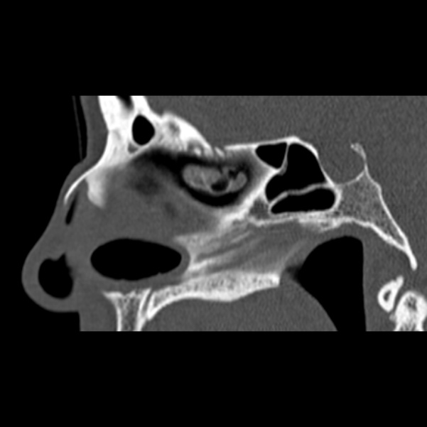 Nasal septal perforation (Radiopaedia 25030-25289 Sagittal bone window 29).jpg