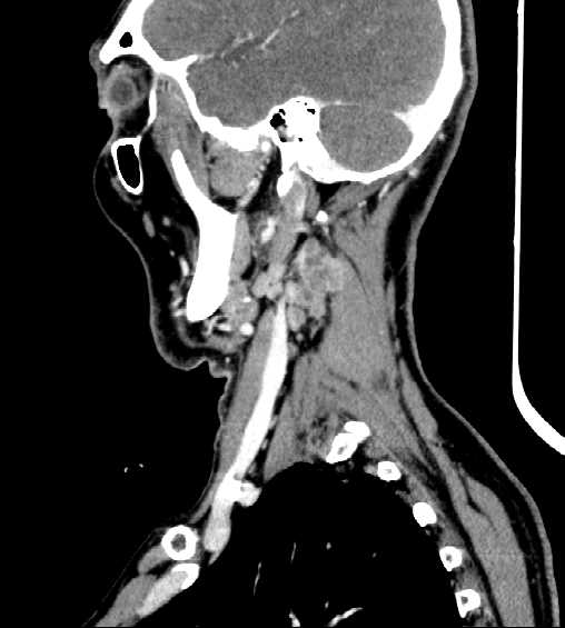 File:Nasopharyngeal carcinoma - infiltrating the clivus (Radiopaedia 62583-70875 C 13).jpg