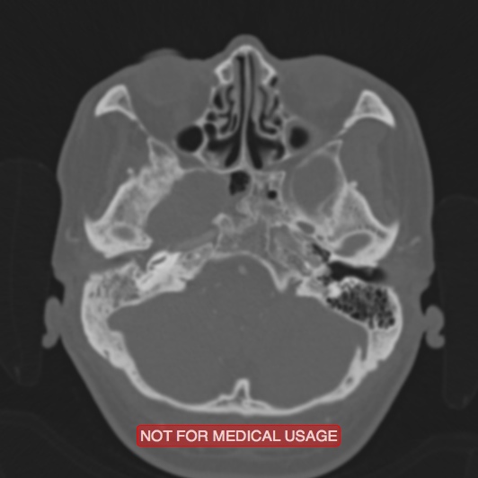 File:Nasopharyngeal carcinoma recurrence - skull base destruction (Radiopaedia 29107-29490 Axial bone window 85).jpg