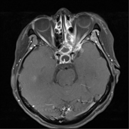 File:Nasopharyngeal carcinoma with cerebral abscess (Radiopaedia 43018-46273 Axial T1 C+ fat sat 11).png