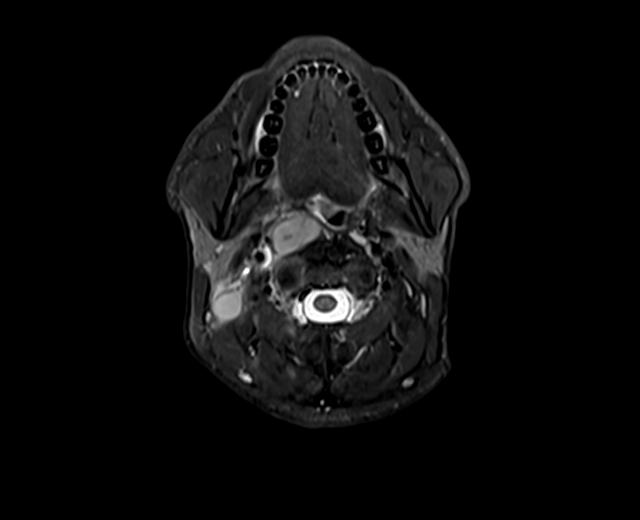 File:Nasopharyngeal carcinoma with perineural spread (Radiopaedia 55030-61380 Axial STIR 20).jpg