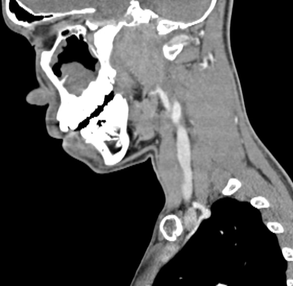File:Nasopharyngeal carcinoma with skull base invasion (Radiopaedia 53415-59705 C 49).jpg
