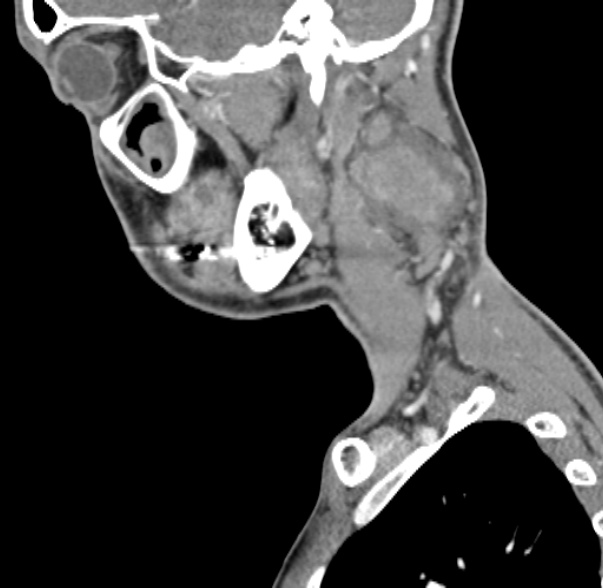 File:Nasopharyngeal carcinoma with skull base invasion (Radiopaedia 53415-59705 C 56).jpg