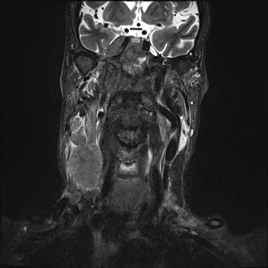 Nasopharyngeal carcinoma with skull base invasion (Radiopaedia 59258-66600 Coronal T2 fat sat 16).jpg