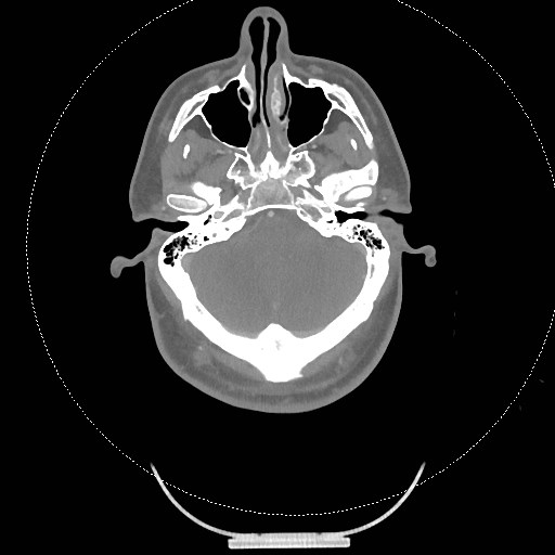 Neck CT angiogram (intraosseous vascular access) (Radiopaedia 55481-61945 B 267).jpg