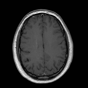 File:Neuro-Behcet's disease (Radiopaedia 21557-21506 Axial T1 C+ 19).jpg