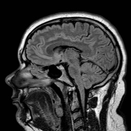 File:Neuro-Behcet's disease (Radiopaedia 21557-21506 Sagittal FLAIR 19).jpg
