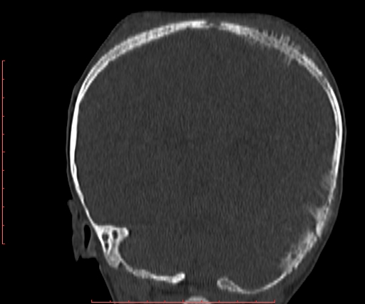 File:Neuroblastoma skull metastasis (Radiopaedia 56053-62683 Coronal bone window 29).jpg