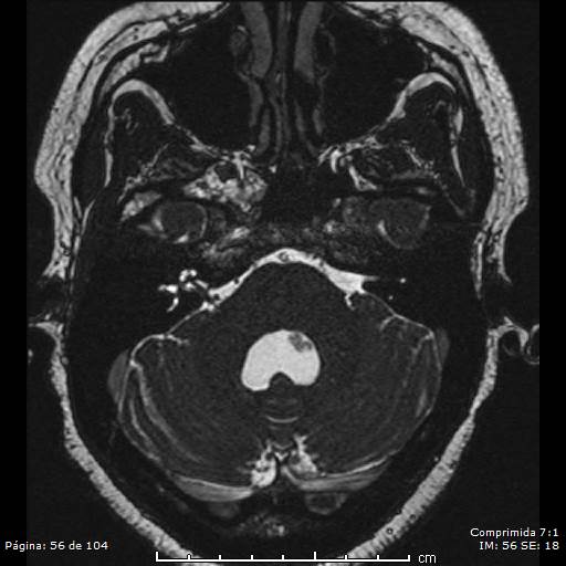 Neurocysticercosis (Radiopaedia 58636-65832 I 56).jpg