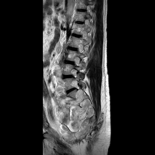 File:Neurofibromatosis type 1- extensive spinal involvement and Christmas tree sign (Radiopaedia 60610-68332 Sagittal T2 6).jpg