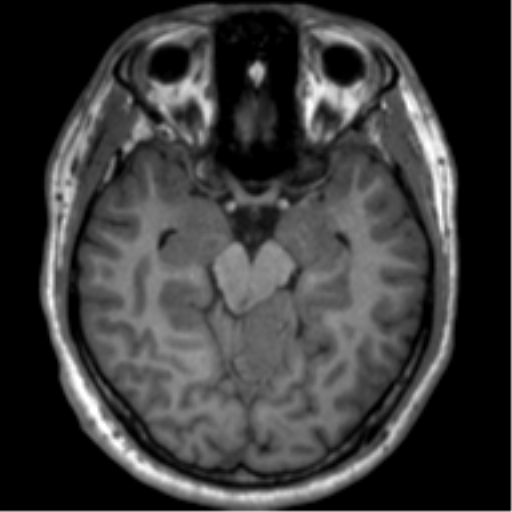 File:Neurofibromatosis type 2 (Radiopaedia 44936-48838 Axial T1 52).png