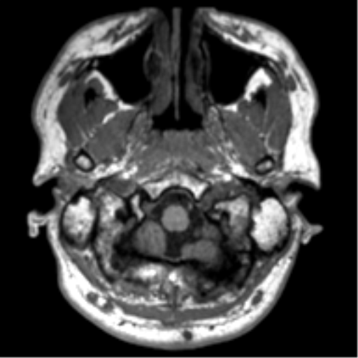 File:Neurofibromatosis type 2 (Radiopaedia 44936-48838 Axial T1 6).png