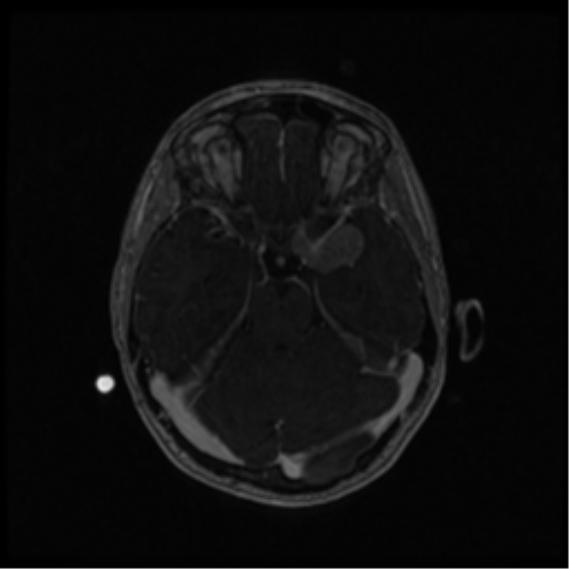 Neurofibromatosis type 2 (Radiopaedia 45229-49244 Axial T1 C+ 49).png