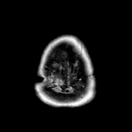 File:Neurofibromatosis type 2 (Radiopaedia 8713-9518 Axial Gradient Echo 1).jpg
