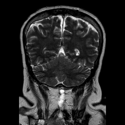 File:Neurofibromatosis type 2 (Radiopaedia 8713-9518 Coronal T2 19).jpg