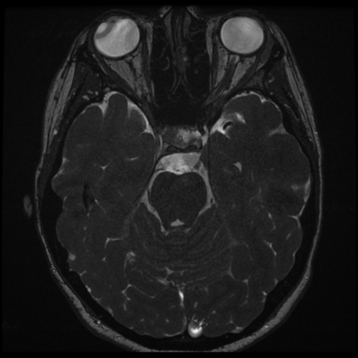 Neurofibromatosis type 2 - bilateral acoustic neuromata (Radiopaedia 40060-42566 Axial FIESTA 70).png
