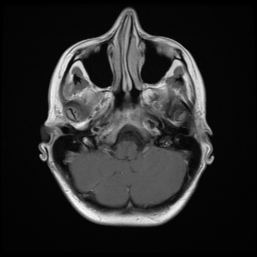 File:Neurofibromatosis type 2 - bilateral acoustic neuromata (Radiopaedia 40060-42566 Axial T1 C+ 4).png