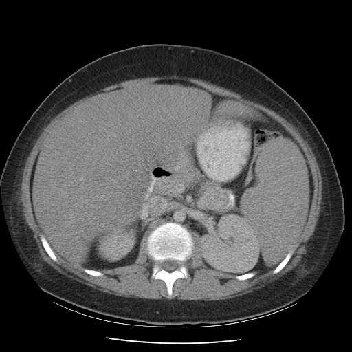 File:Non-Hodgkin lymphoma involving pelvis (Radiopaedia 21281-21197 A 27).jpg