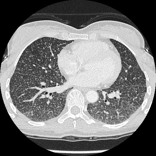 File:Non-small cell lung cancer with miliary metastases (Radiopaedia 23995-24193 Axial lung window 15).jpg
