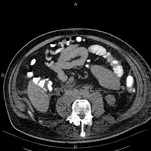 File:Non Hodgkin lymphoma in a patient with ankylosing spondylitis (Radiopaedia 84323-99621 Axial non-contrast 42).jpg