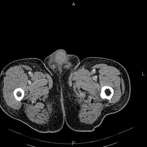 File:Non Hodgkin lymphoma in a patient with ankylosing spondylitis (Radiopaedia 84323-99621 B 73).jpg